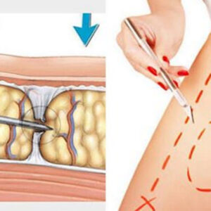 subincisao